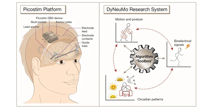 Epilepsy implant