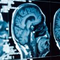Brain CT scan